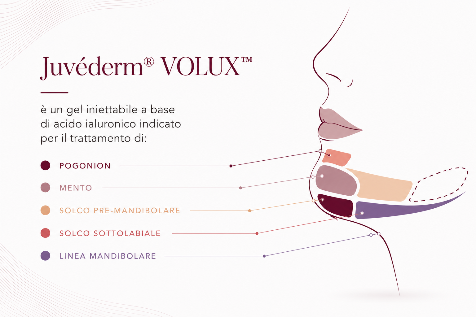 Juvederm-volux-Mento-mandibola