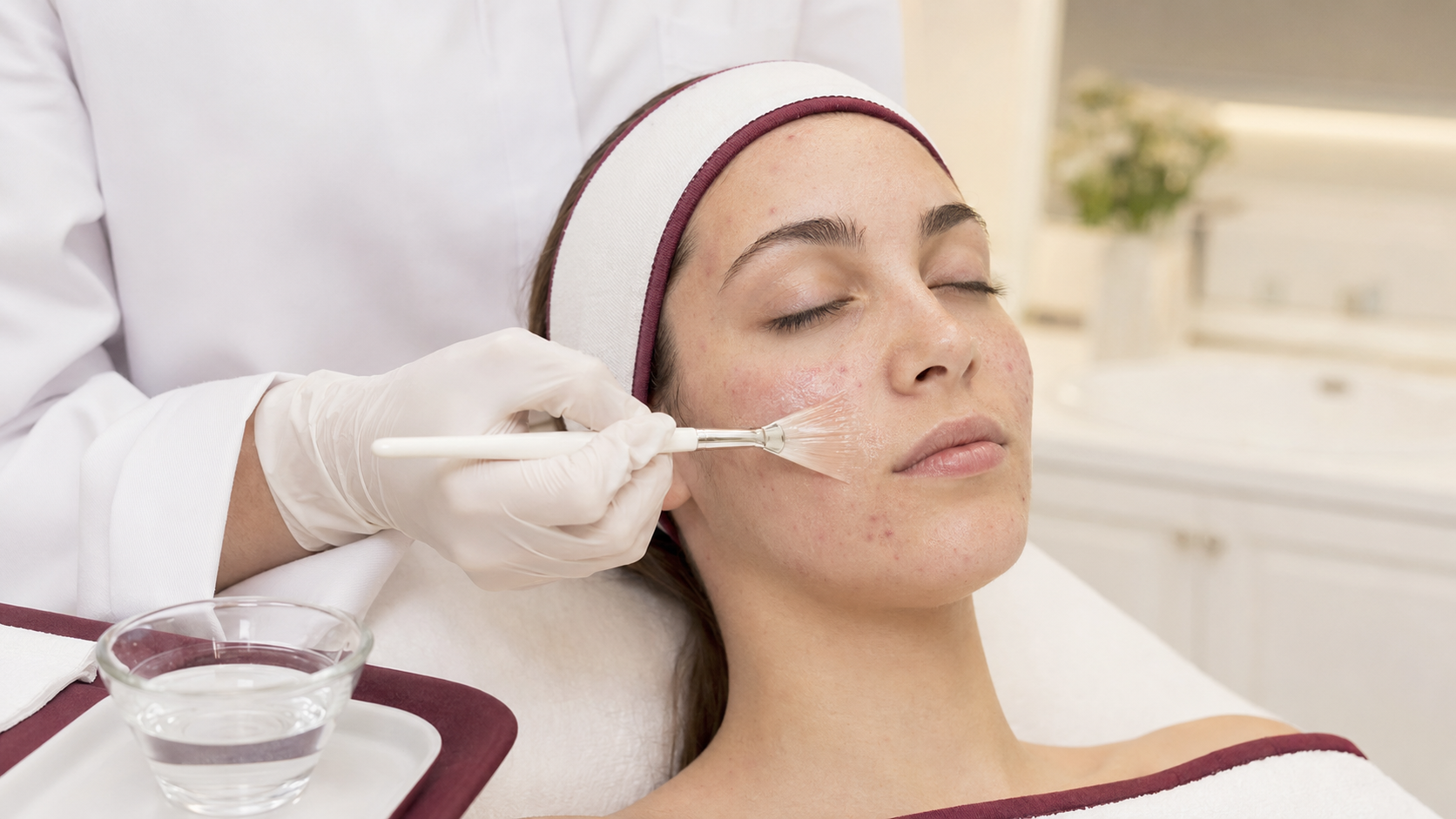 Acne-in-fase-attiva